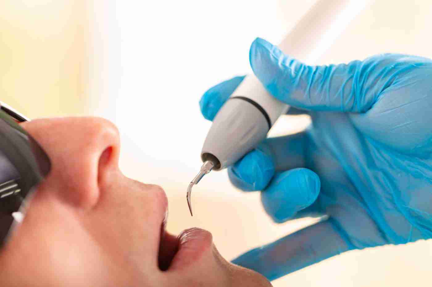 Ultrasonic teeth cleaning close-up at Infinity Smiles, Flushing NY