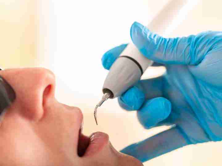 Ultrasonic teeth cleaning close-up at Infinity Smiles, Flushing NY