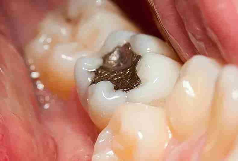 Importance Of Adult Tooth Decay