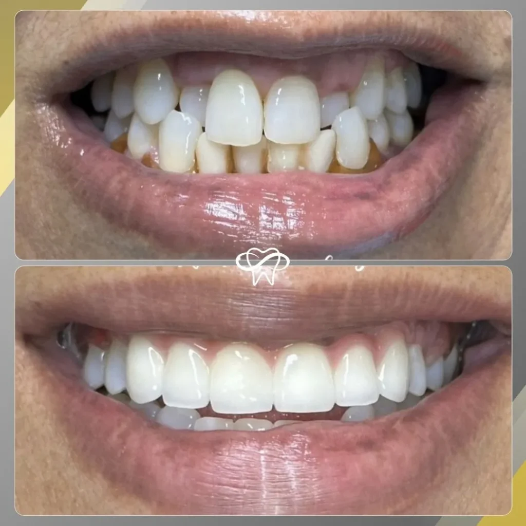 Before and After Full Mouth Reconstruction Treatment by Dentist in Flushing NY