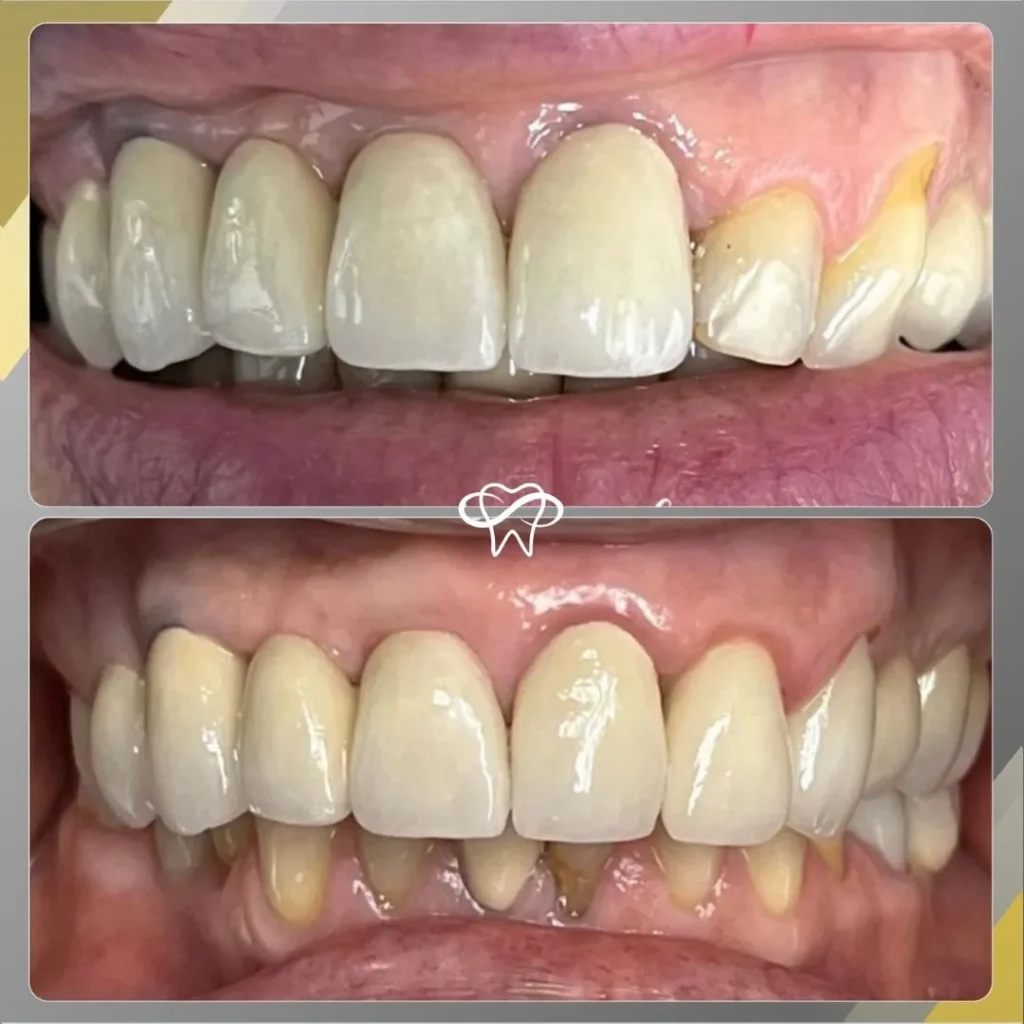 Before and After Full Mouth Reconstruction Treatment by Dentist in Flushing NY