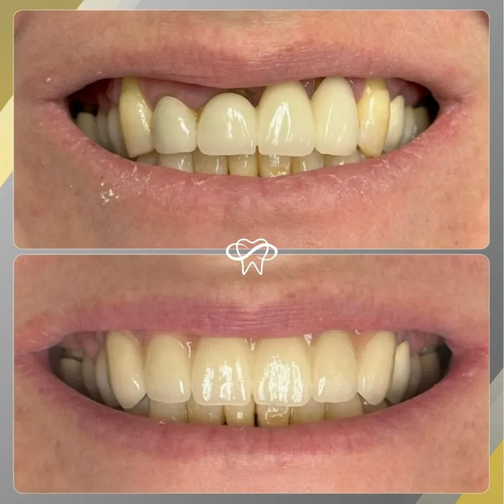 Before and After Full Mouth Reconstruction Treatment by Dentist in Flushing NY