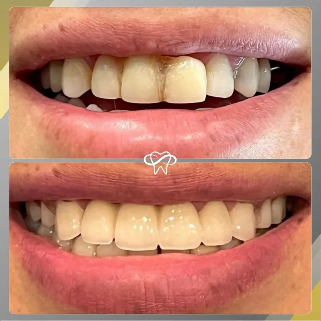 Before and After Dental Bridge Treatment by Dentist in Flushing NY