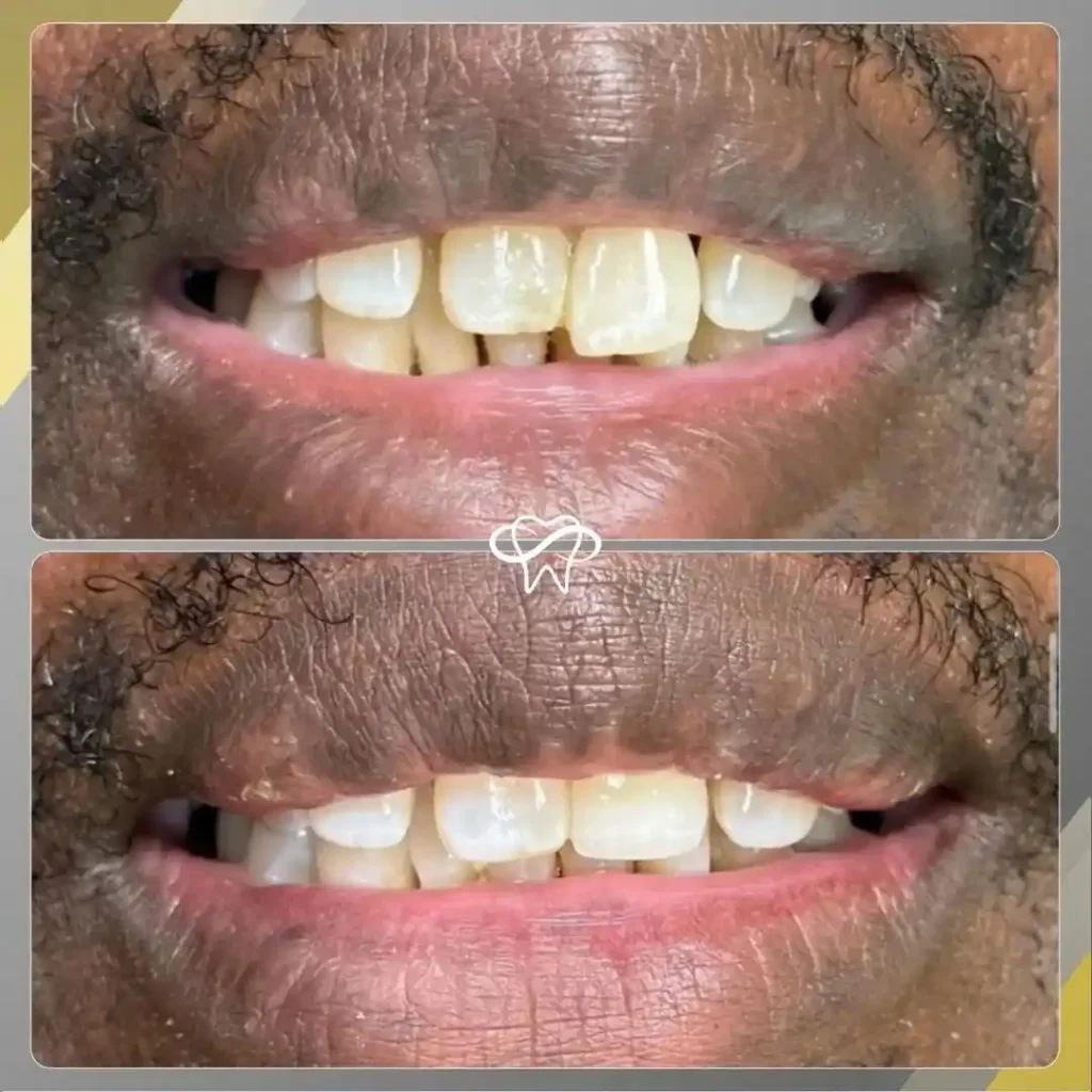 Before and After Dental Fillings Treatment by Dentist in Flushing NY