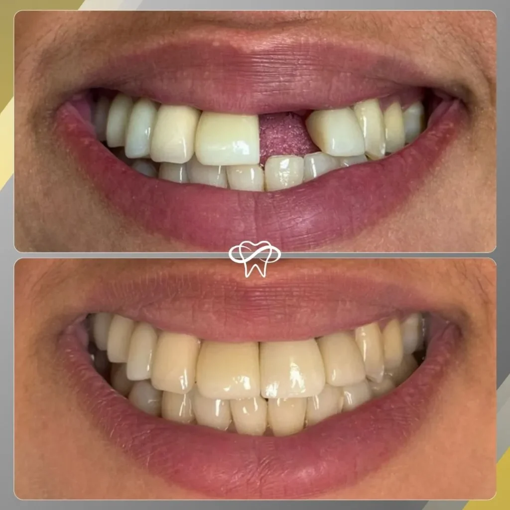 Before and After Dental Implant Treatment by Dentist in Flushing NY