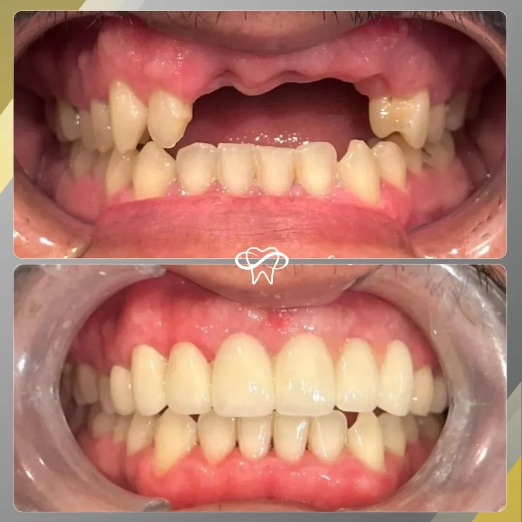 Before and After Dental Implant Treatment by Dentist in Flushing NY