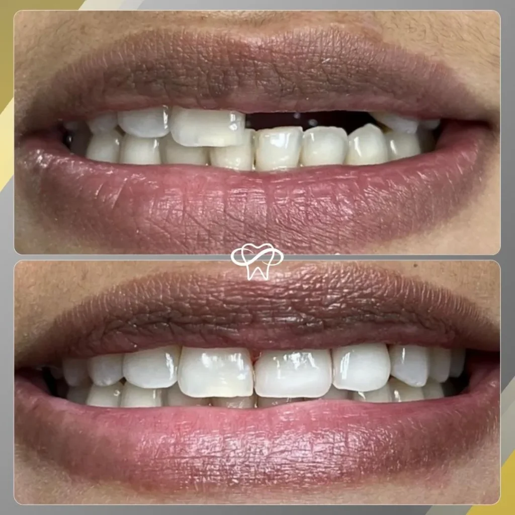 Before and After Dental Implant Treatment by Dentist in Flushing NY