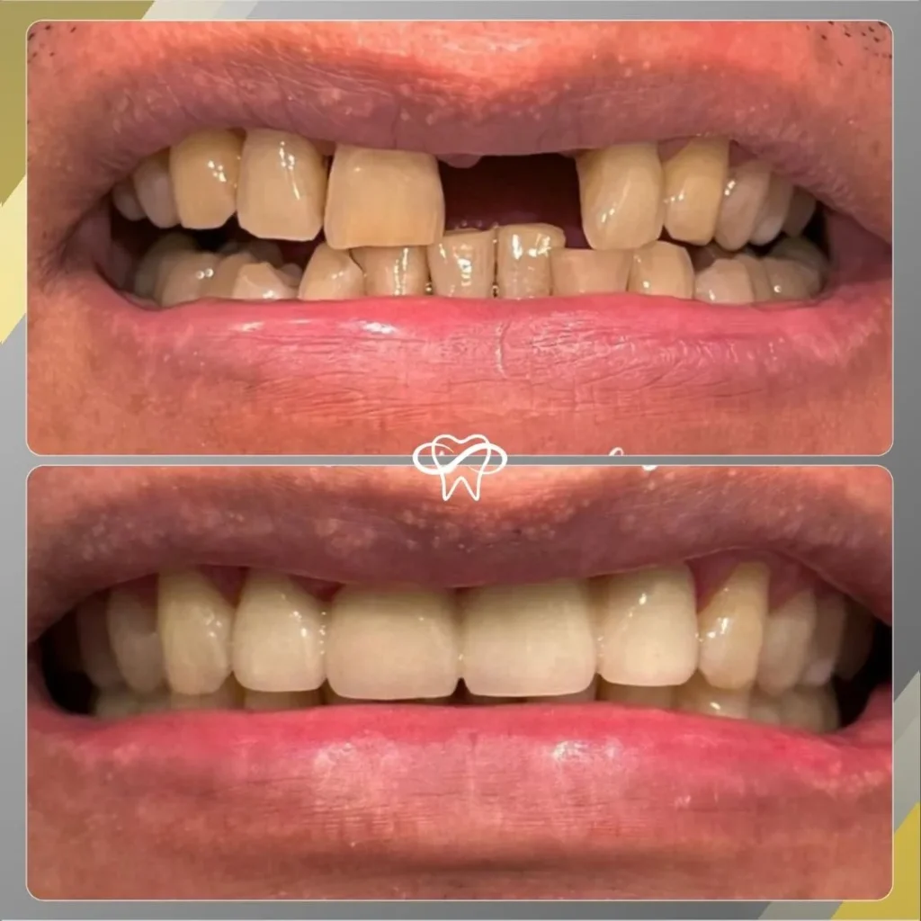 Before and After Dental Mini Implant Treatment by Dentist in Flushing NY