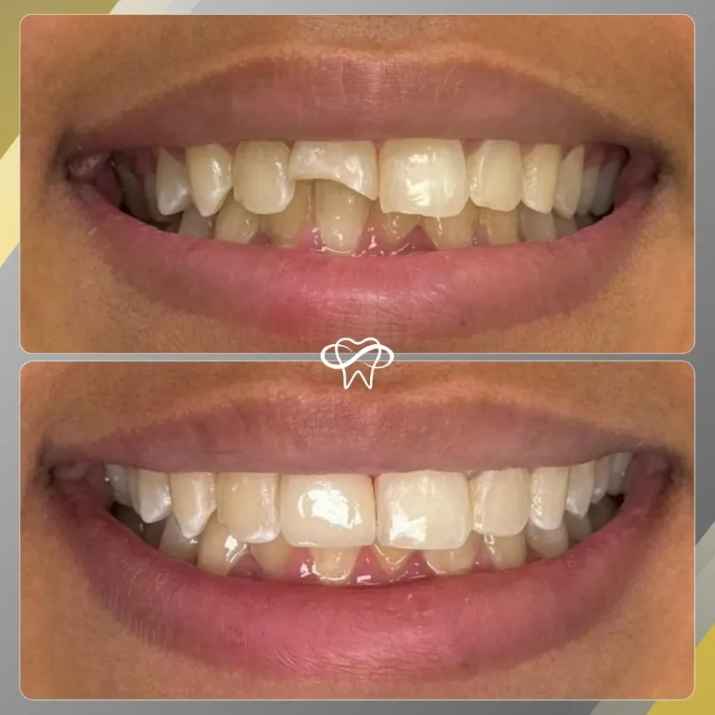 Before and After Dental Veneer Treatment by Dentist in Flushing NY