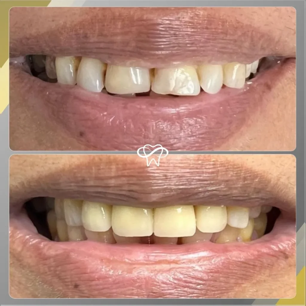 Before and After Dental Veneer Treatment by Dentist in Flushing NY