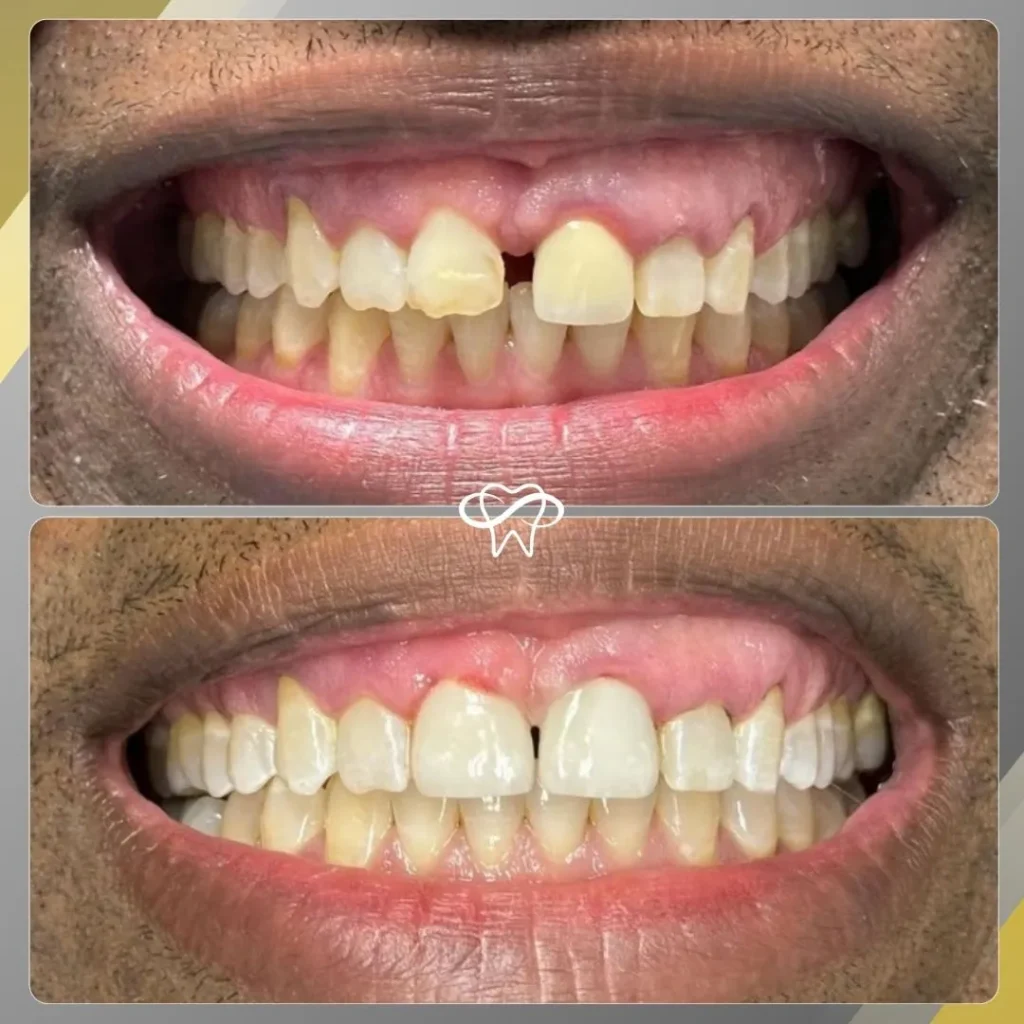 Before and After Dental Veneer Treatment by Dentist in Flushing NY