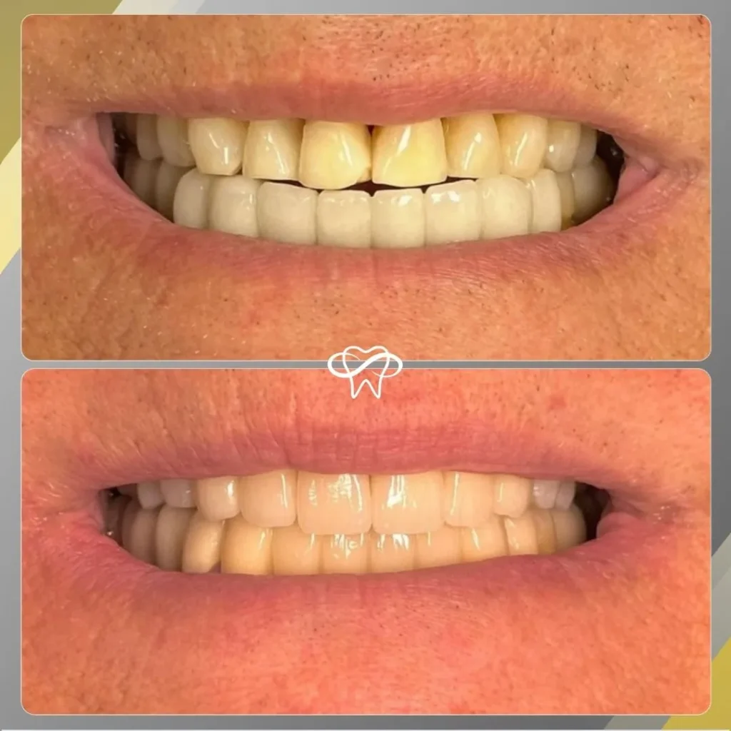 Before and After Dental Veneer Treatment by Dentist in Flushing NY