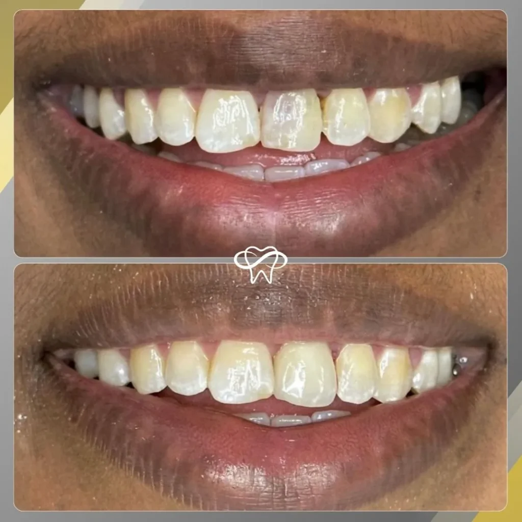 Before and After Dental Veneer Treatment by Dentist in Flushing NY