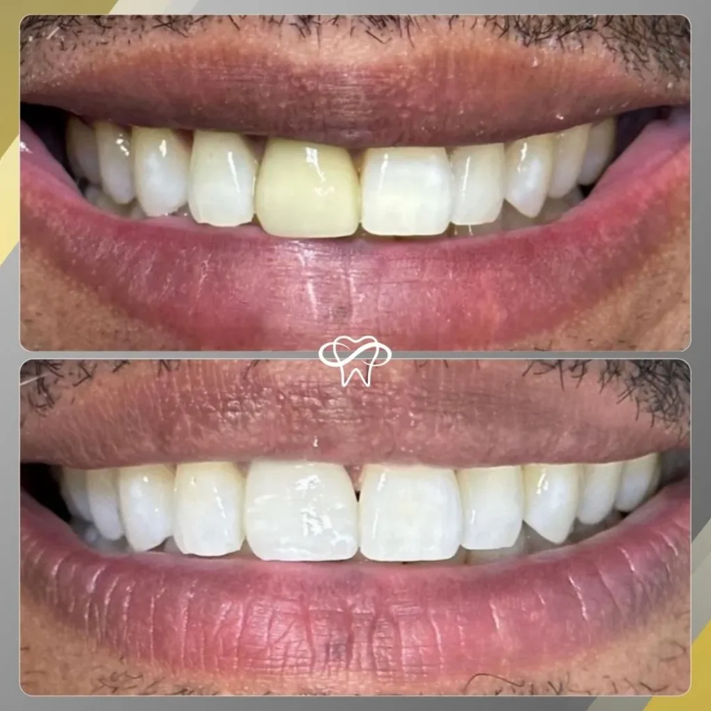 Before and After Dental Veneer Treatment by Dentist in Flushing NY