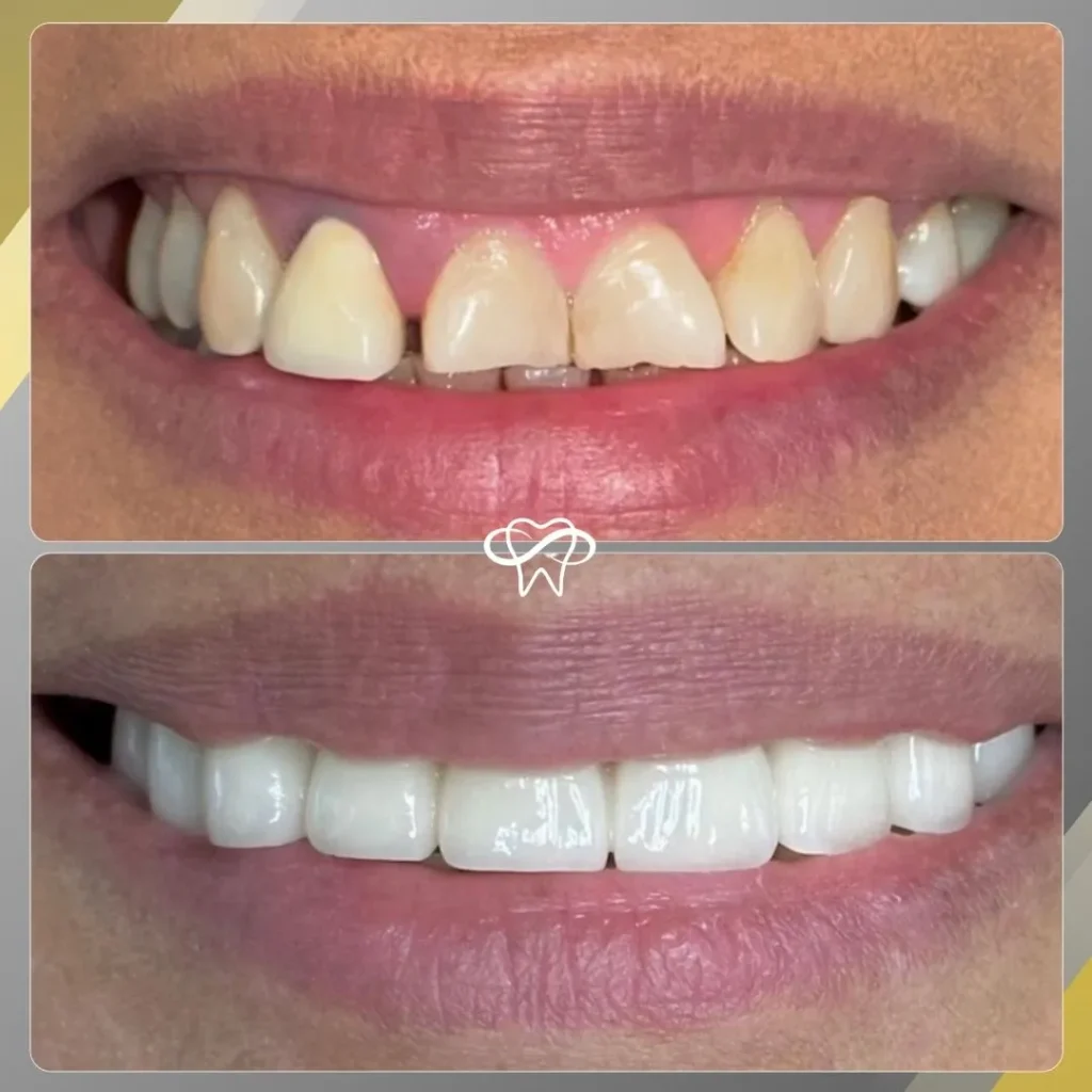 Before and After Dental Veneer Treatment by Dentist in Flushing NY