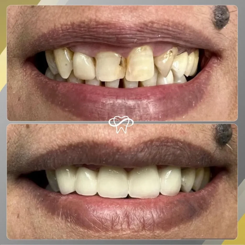 Before and After Full Mouth Reconstruction Dental Treatment by Dentist in Flushing NY