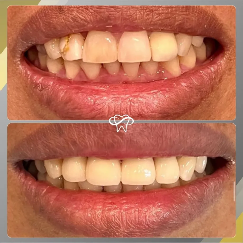 Before and After Full Mouth Reconstruction Treatment by Dentist in Flushing NY