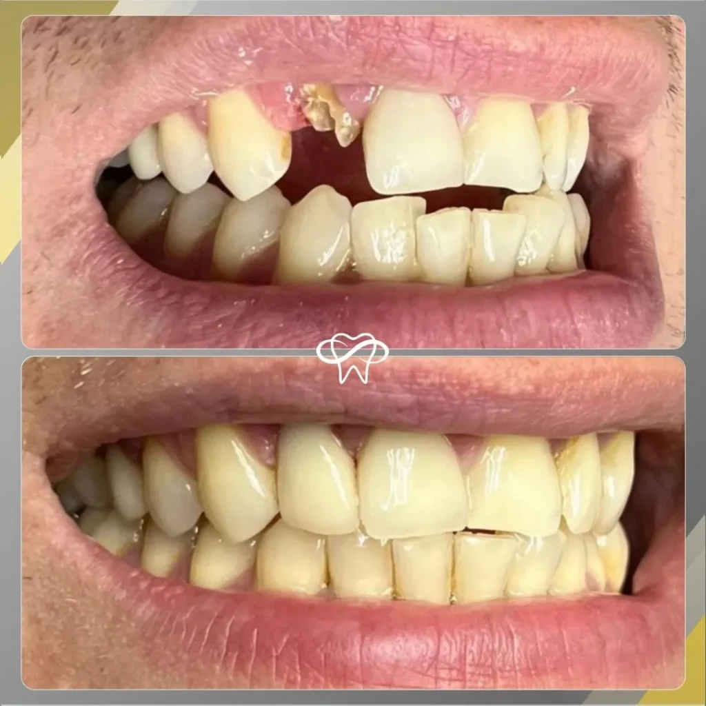 Before and After Mini Dental Implant Treatment by Dentist in Flushing NY
