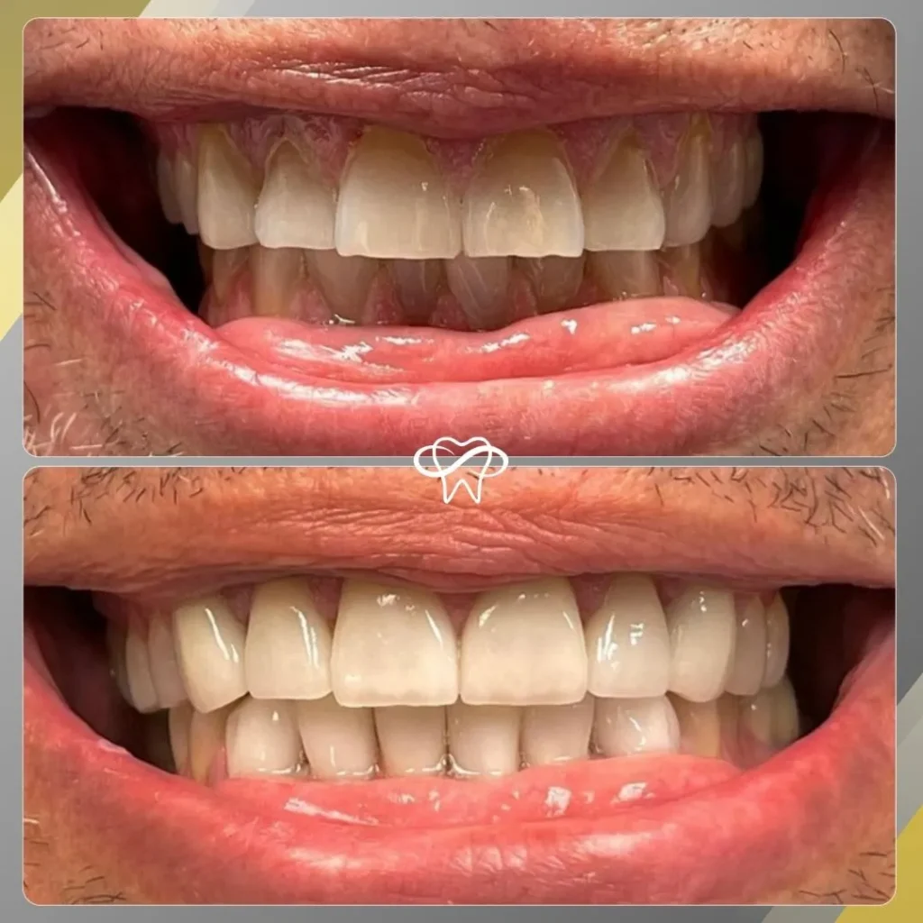 Before and After Restorative Dentistry Treatment by Dentist in Flushing NY