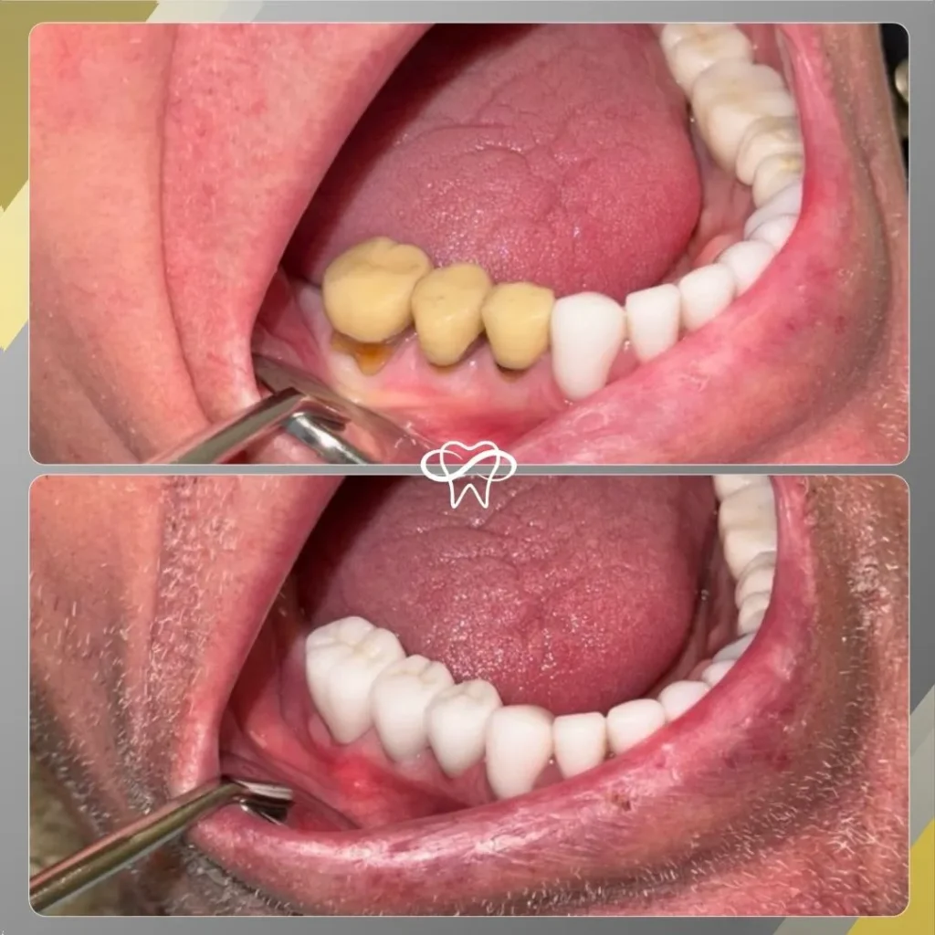 Before and After Root Canal Treatment by Dentist in Flushing NY