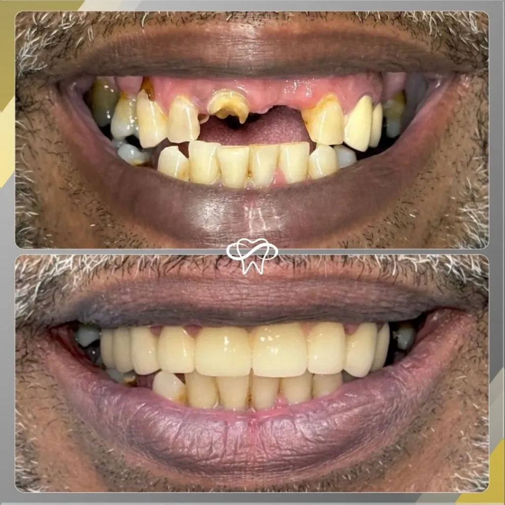 Before and After Dental Implant Treatment by Dentist in Flushing NY