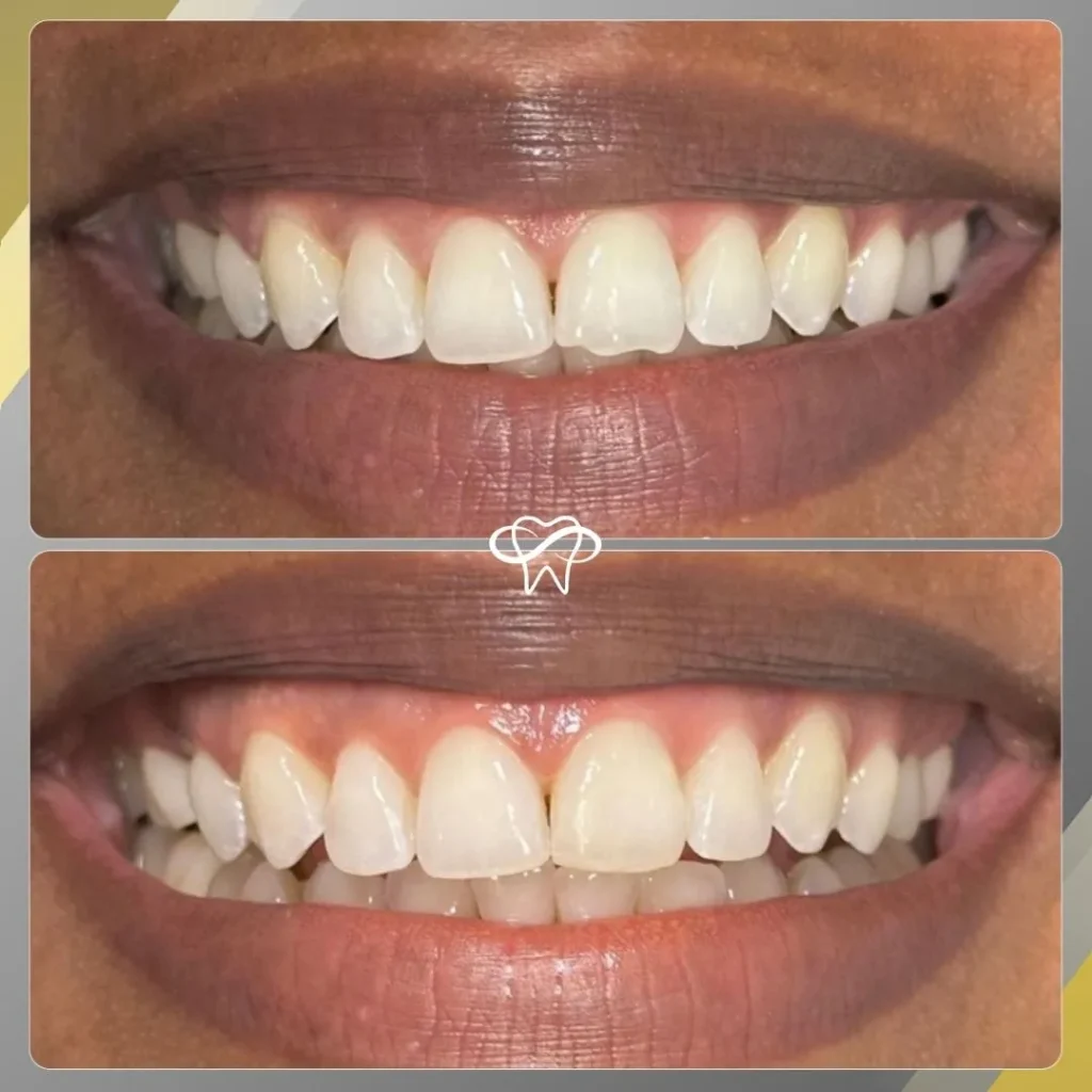 Before and After Teeth Whitening Treatment by Dentist in Flushing NY