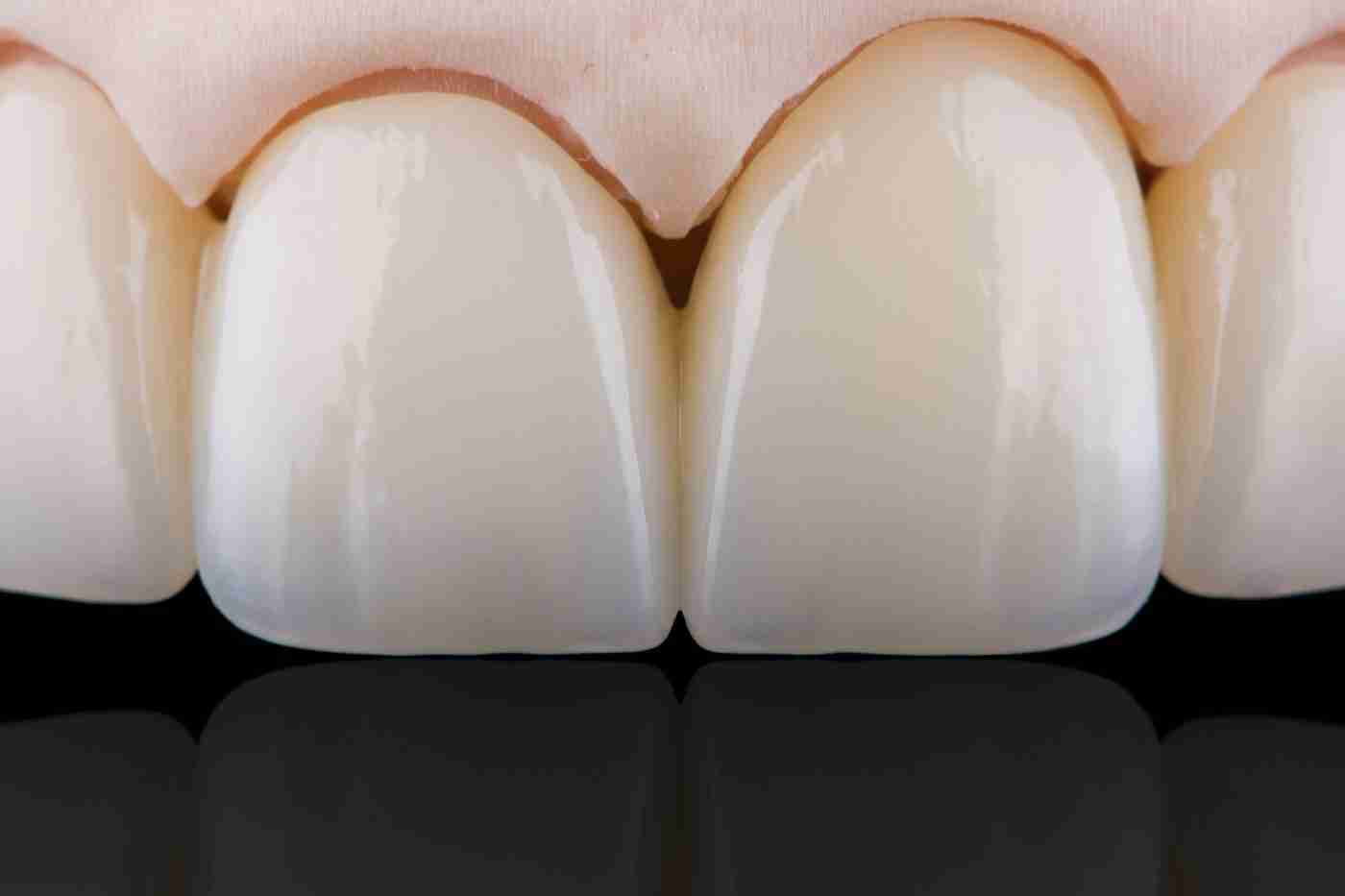 Zirconia dental bridge for the upper front teeth