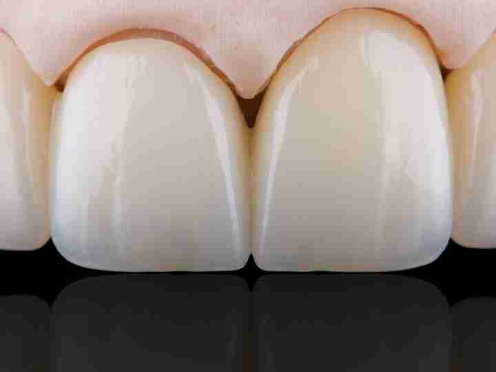 Zirconia dental bridge for the upper front teeth