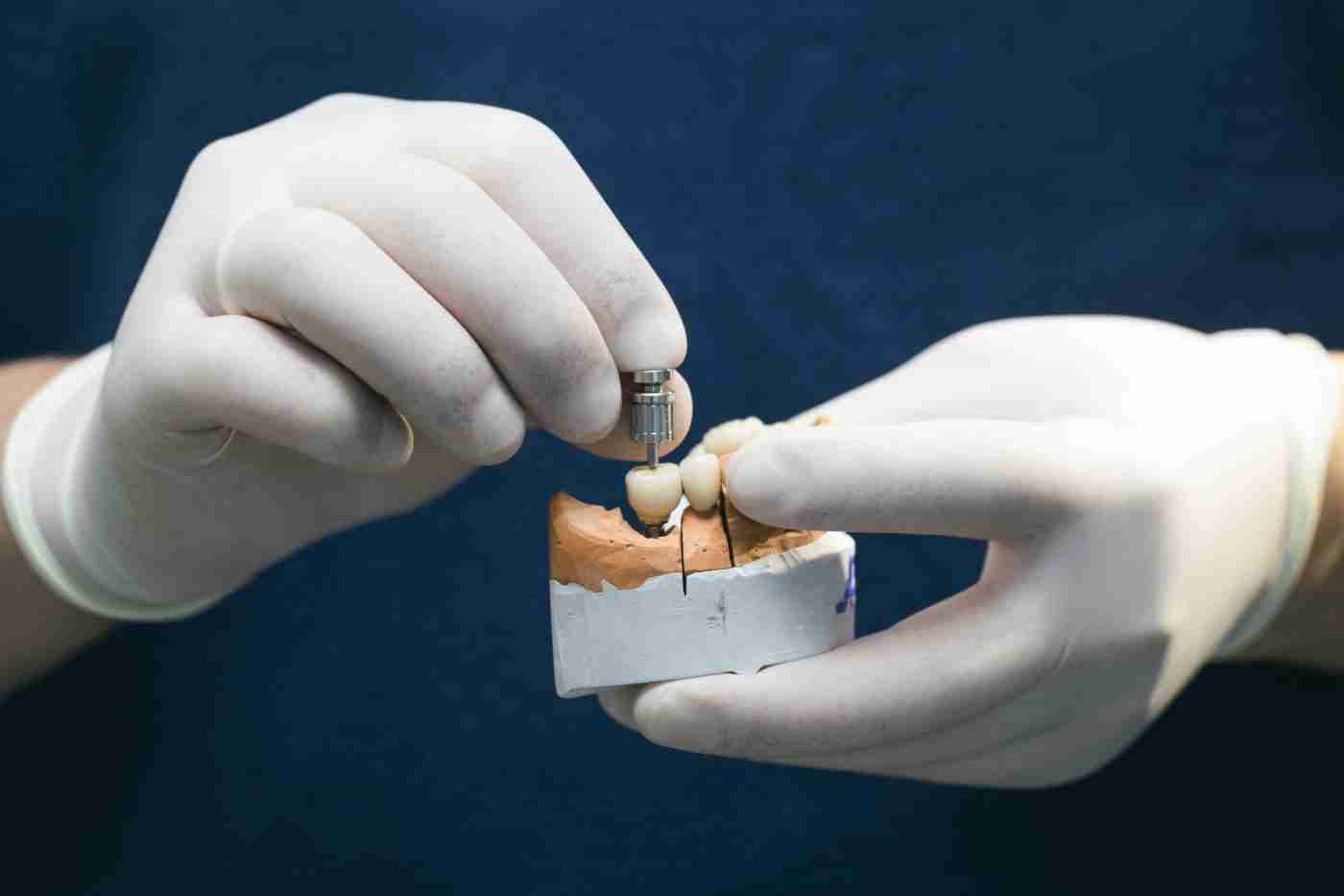 Dentist holding a model with implant-supported restorations