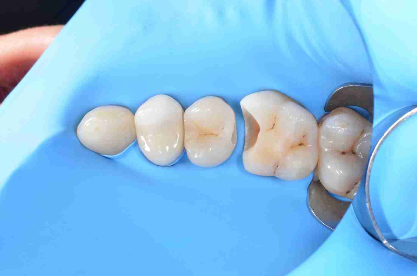 Ceramic inlay and onlay restorations close-up