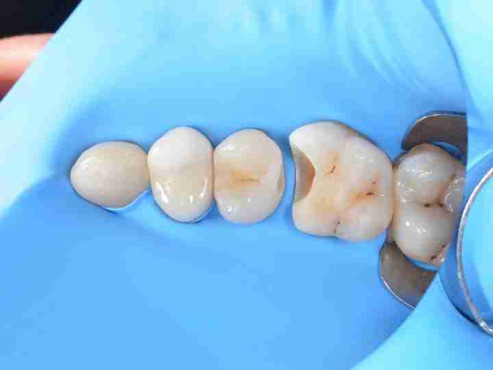Ceramic inlay and onlay restorations close-up