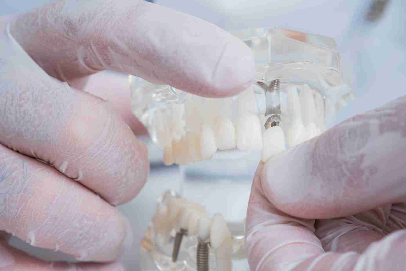 Dentist showing dental implants on a model of the jaw