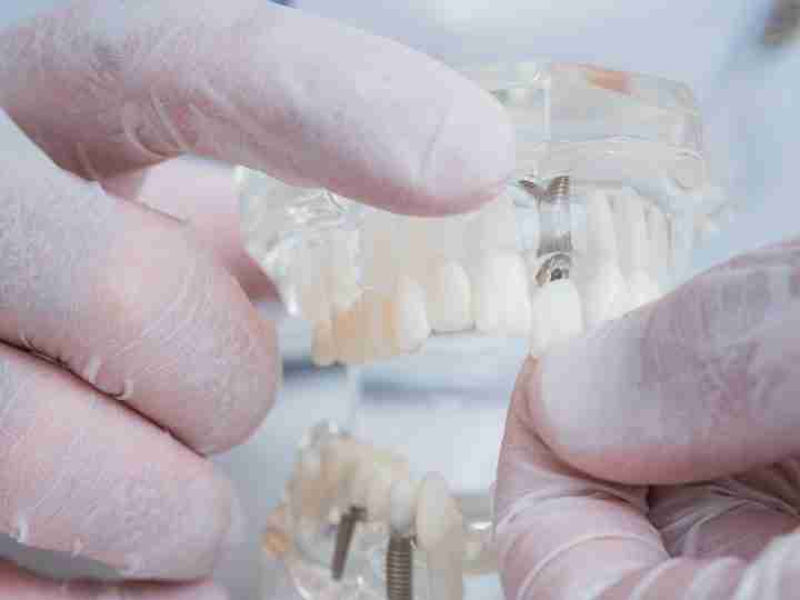Dentist showing dental implants on a model of the jaw