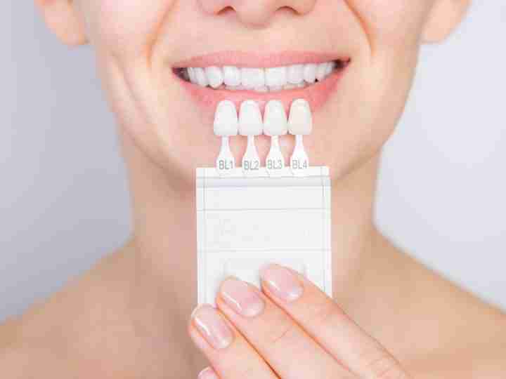 Teeth whitening shade guide held against a bright smile
