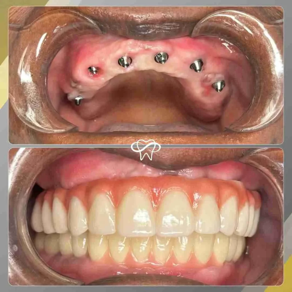 Before and After of All on Eight Dental Implant Treatment by Dentist in Flushing NY
