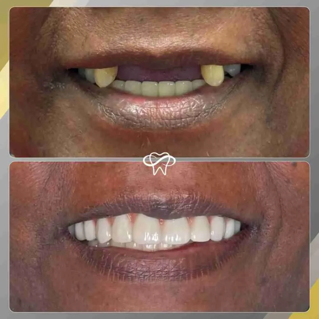 Before and After of All on Four Dental Implant Treatment by Dentist in Flushing NY