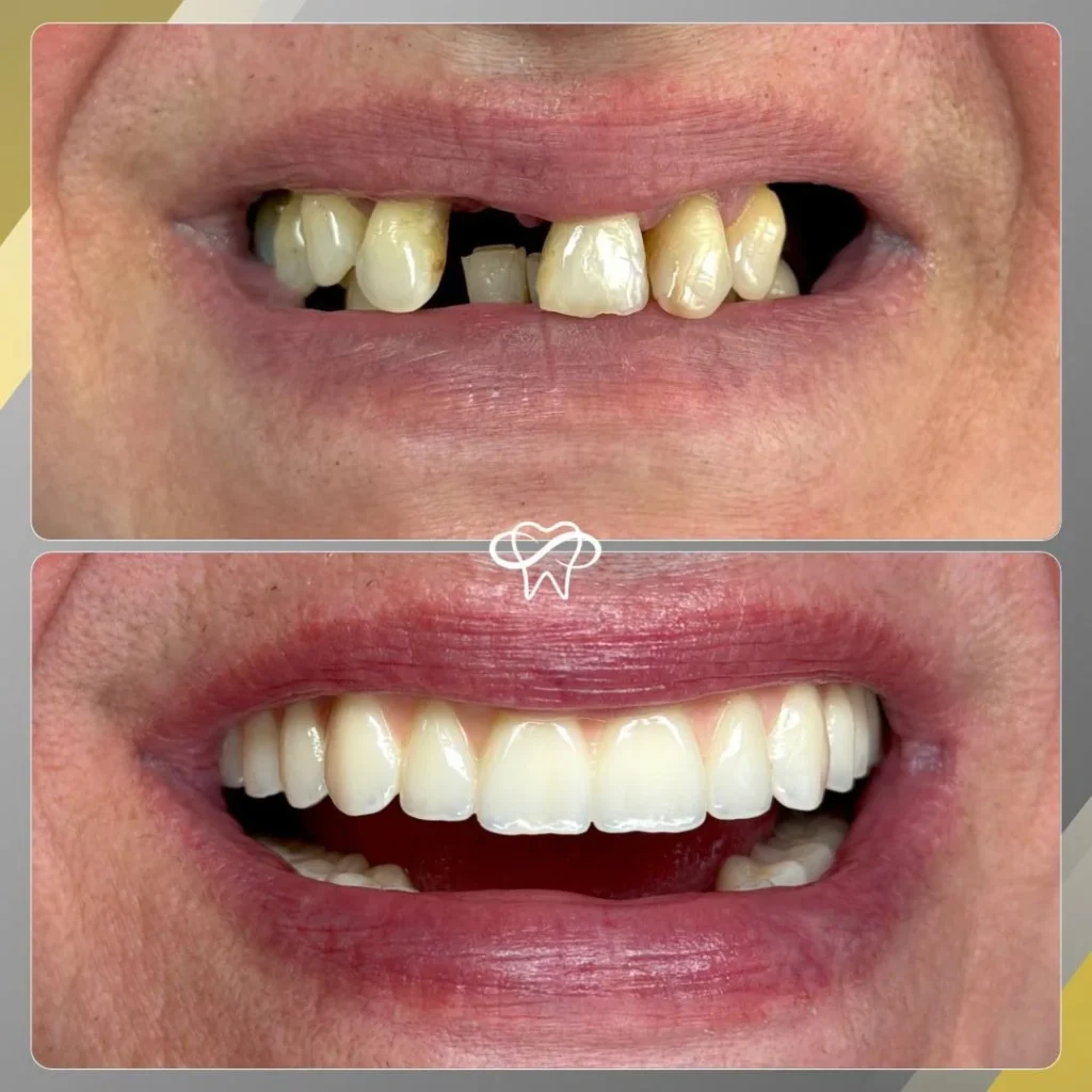 Before and after: All-on-X Implants, Full Mouth Rehabilitation