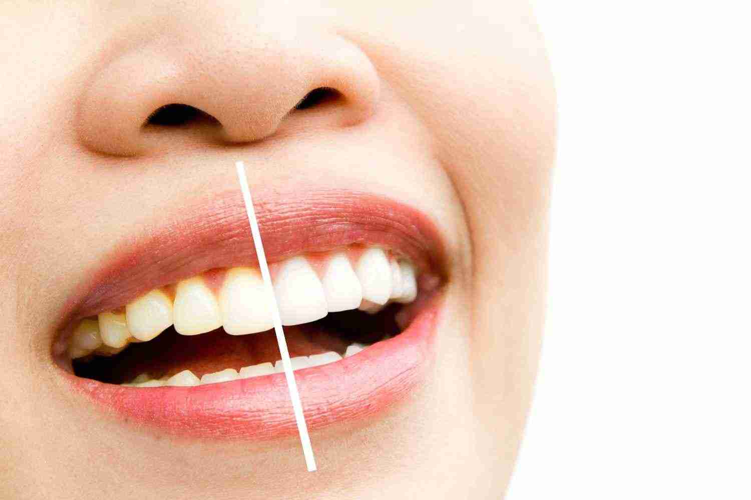 Veneers vs Teeth Whitening Comes Down to Why Your Teeth Look Discolored | Infinity Smiles