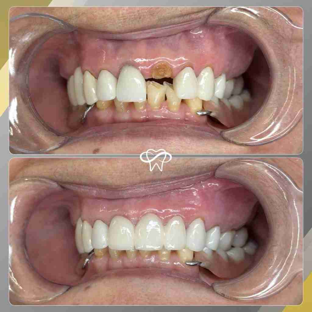 Before and after smile transformation at Infinity Smiles dental office in Flushing NY