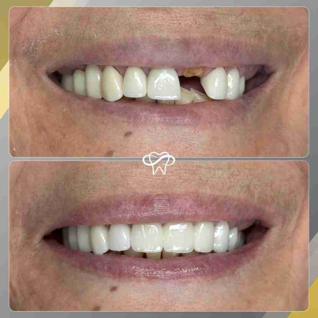 Before and after smile transformation at Infinity Smiles dental office in Flushing NY