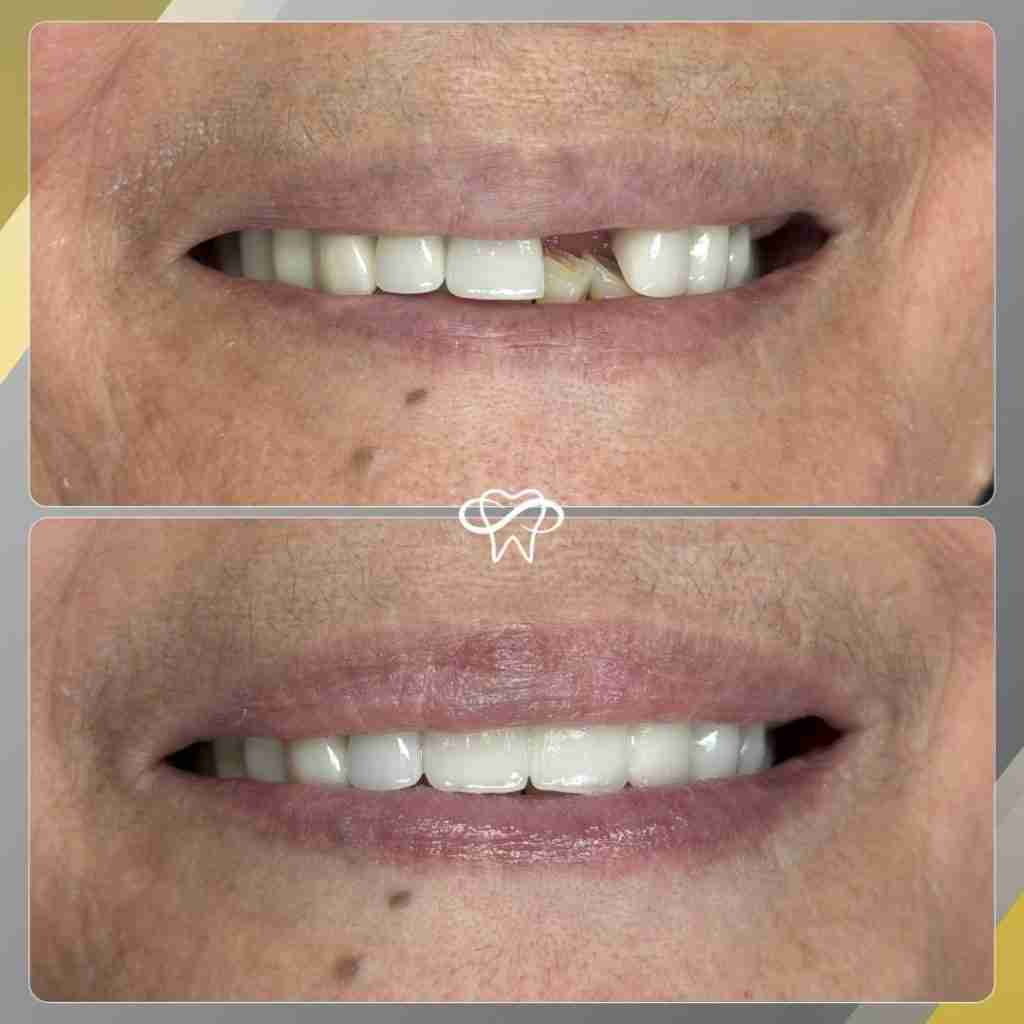 Before and after smile transformation at Infinity Smiles dental office in Flushing NY