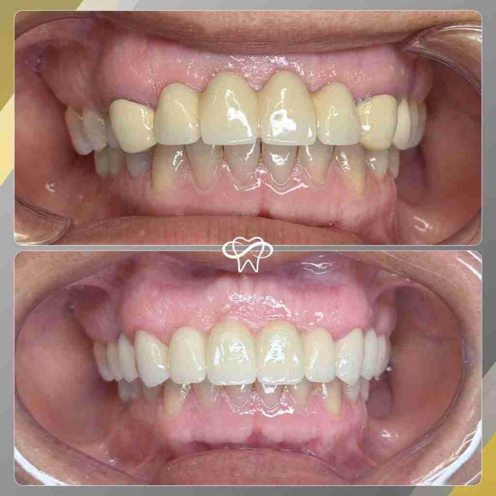 Before and after smile transformation at Infinity Smiles dental office in Flushing NY