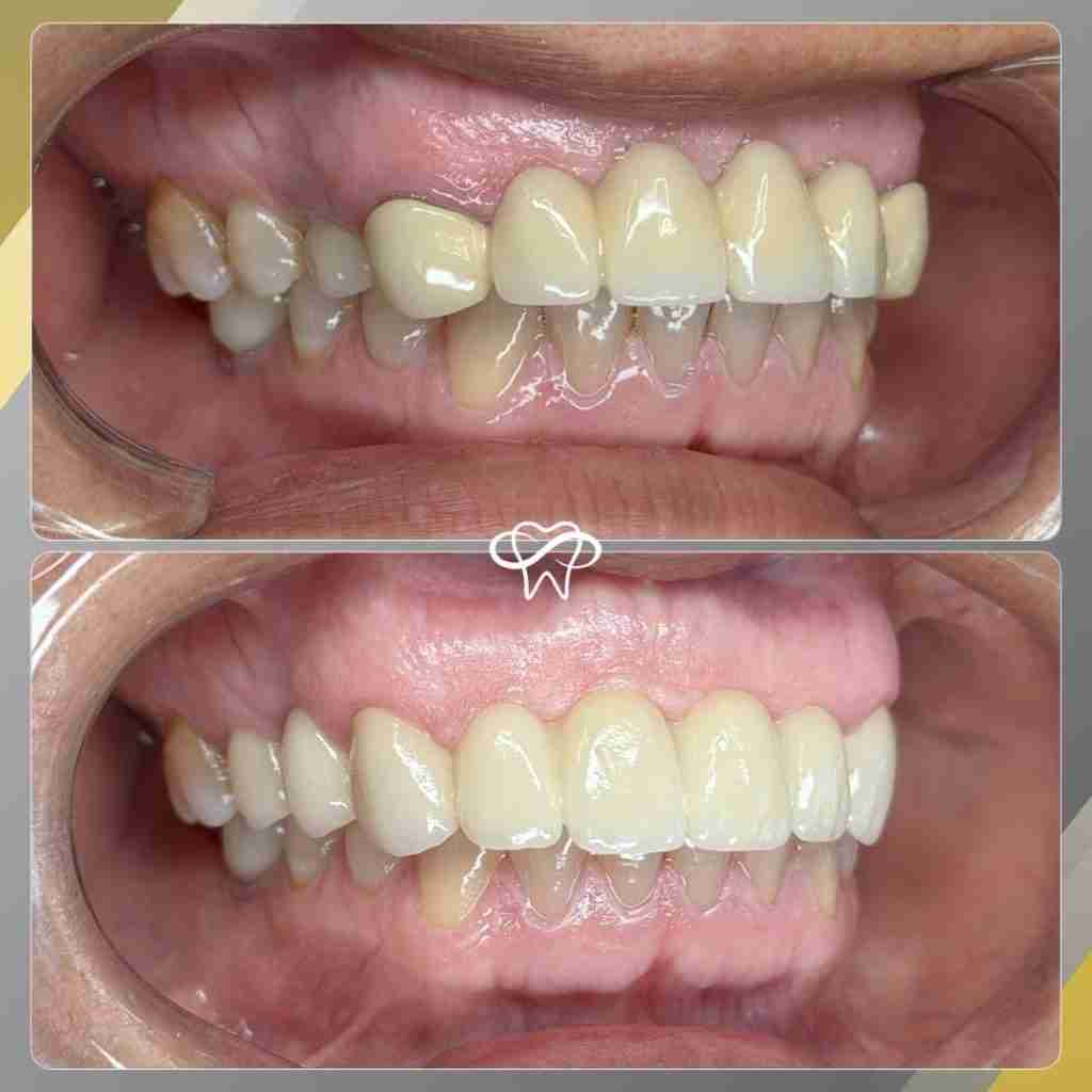 Before and after smile transformation at Infinity Smiles dental office in Flushing NY