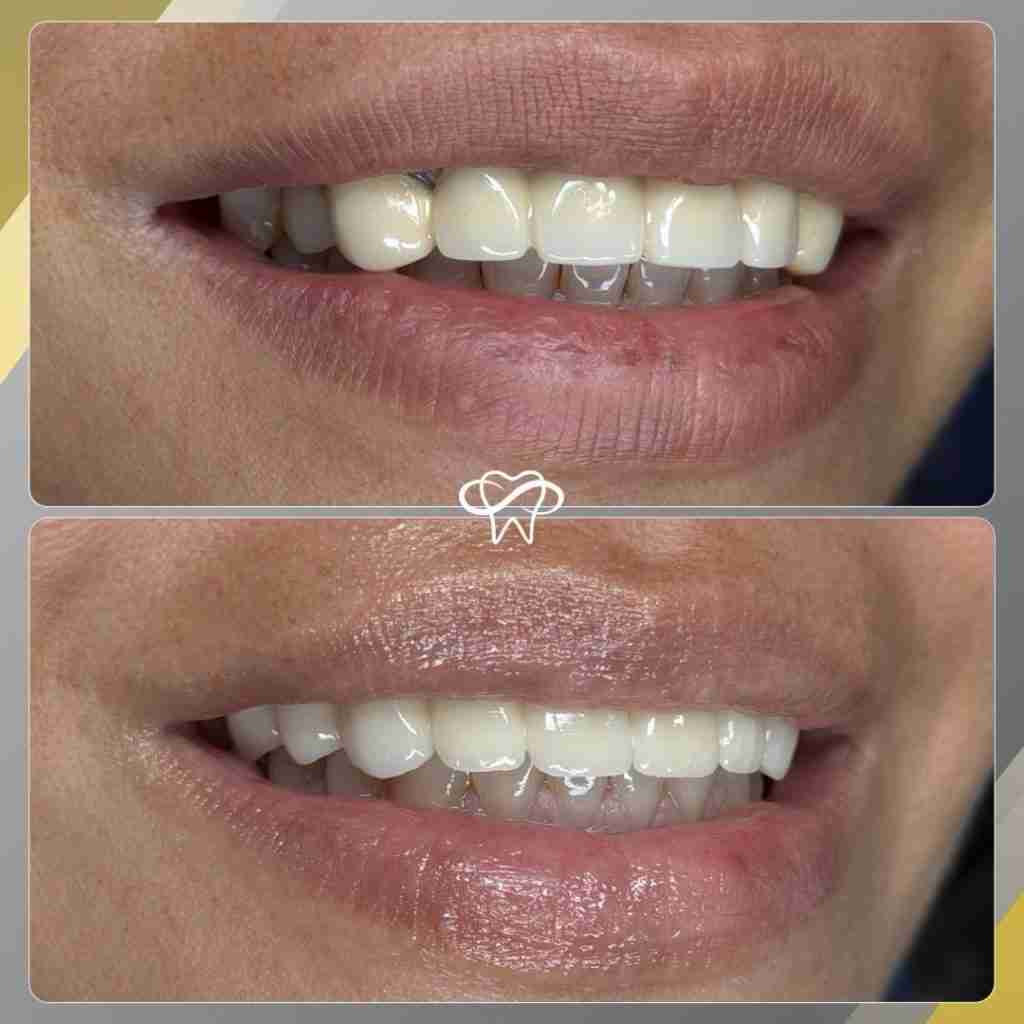 Before and after smile transformation at Infinity Smiles dental office in Flushing NY