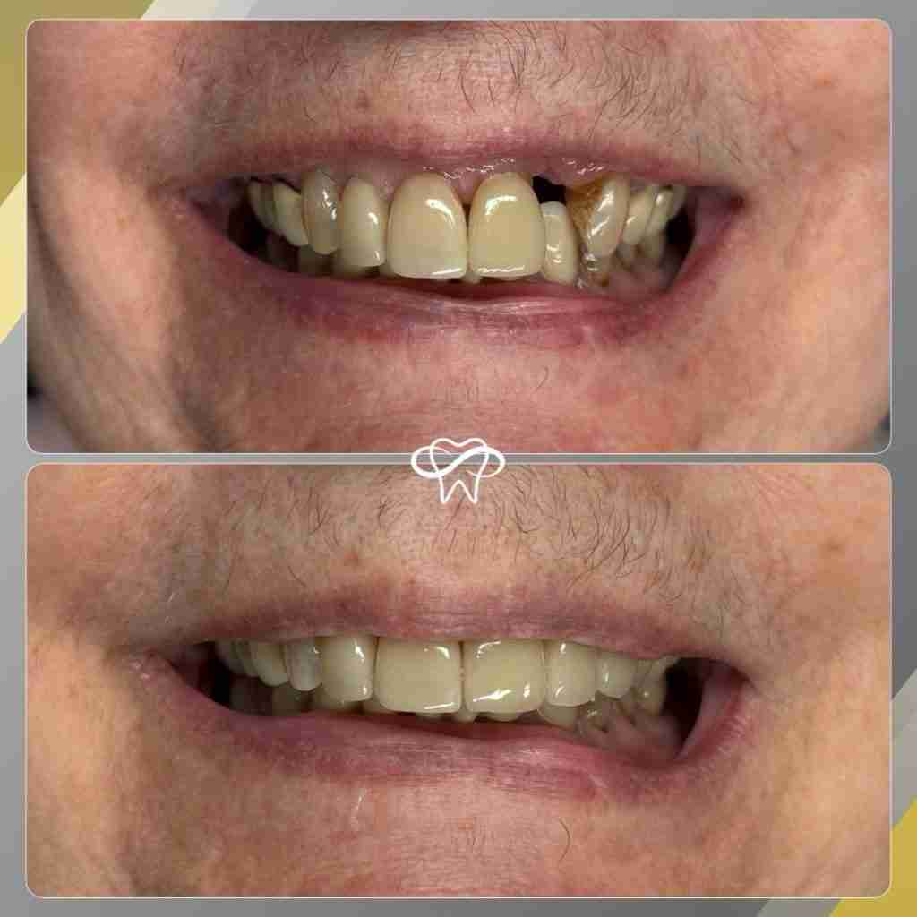 Before and after smile transformation at Infinity Smiles dental office in Flushing NY
