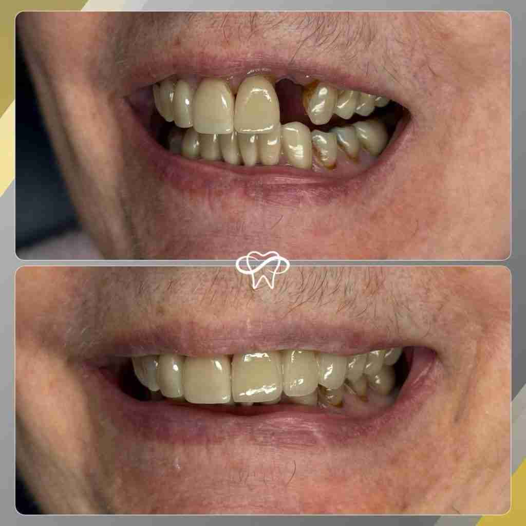 Before and after smile transformation at Infinity Smiles dental office in Flushing NY