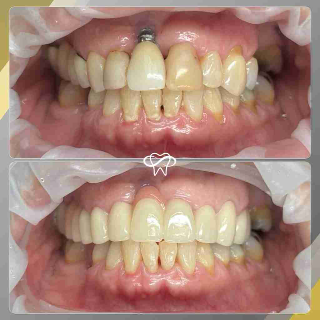 Before and after smile transformation at Infinity Smiles dental office in Flushing NY