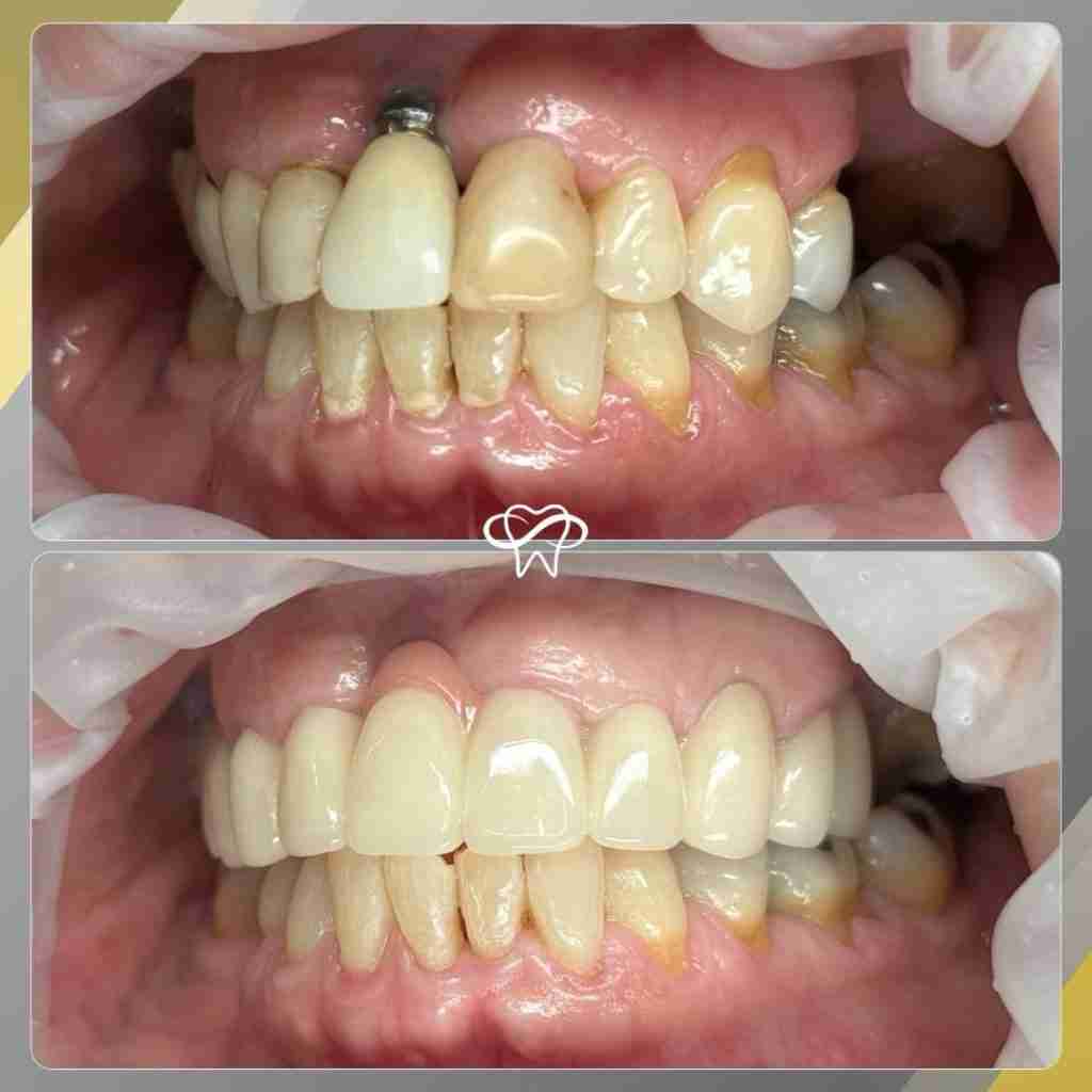 Before and after smile transformation at Infinity Smiles dental office in Flushing NY
