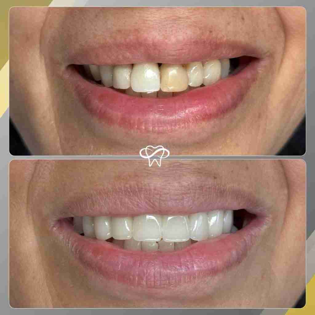 Before and after smile transformation at Infinity Smiles dental office in Flushing NY