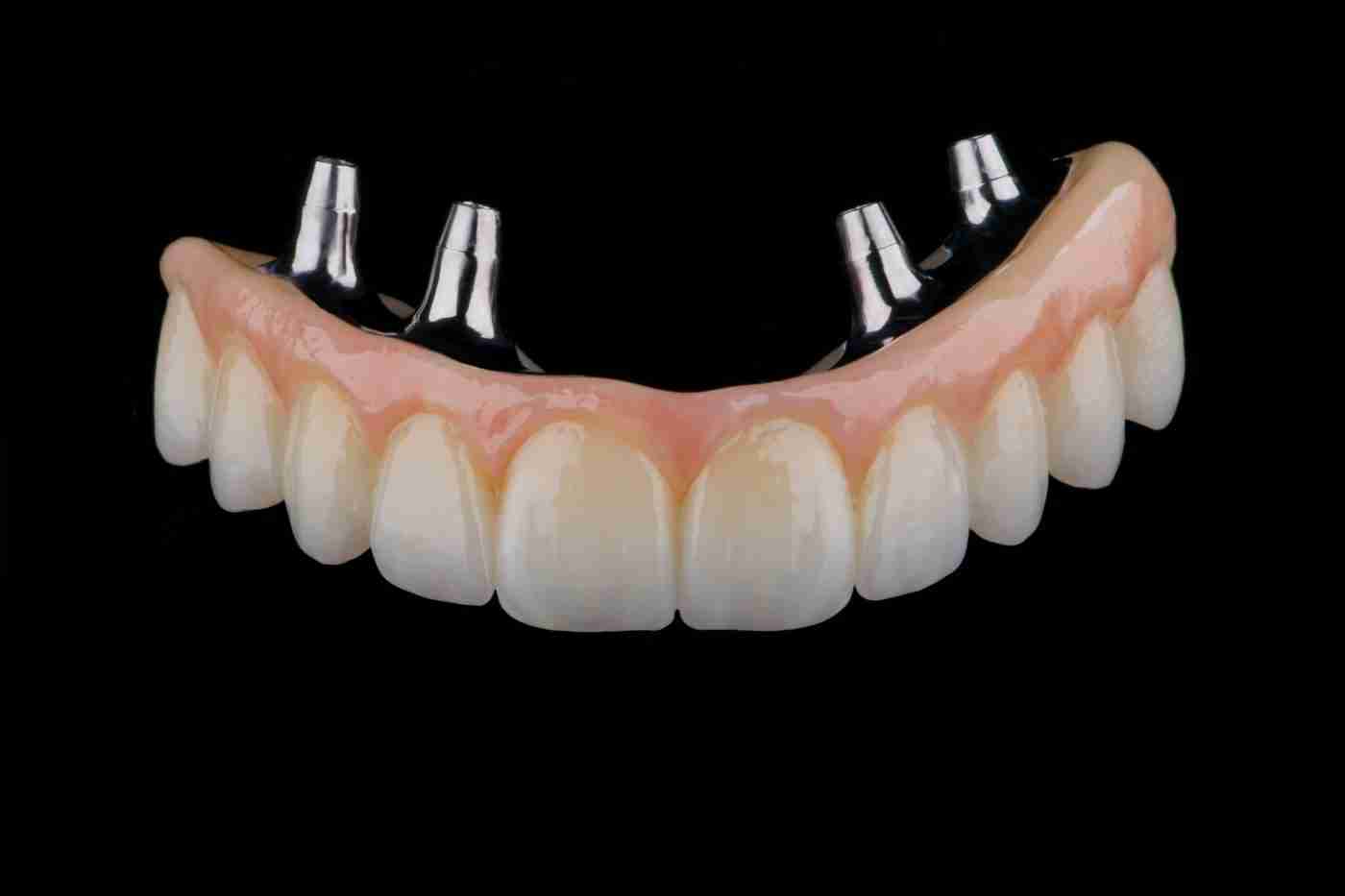Full-arch zirconia prosthesis on a titanium bar for All-on-X implants